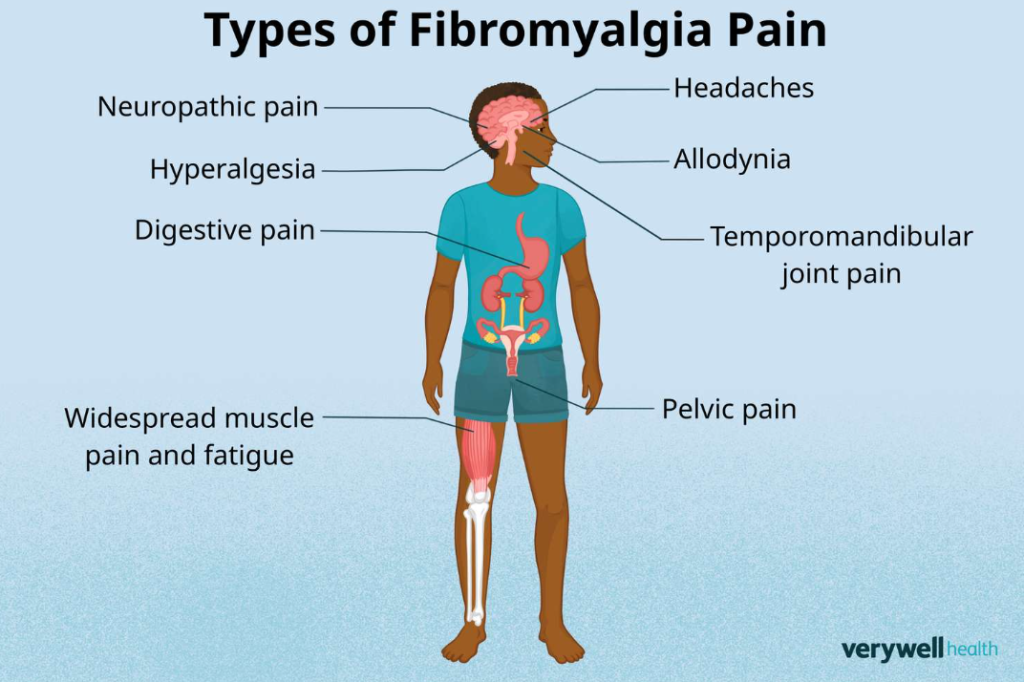 Gejala Fibromyalgia yang Sering Muncul