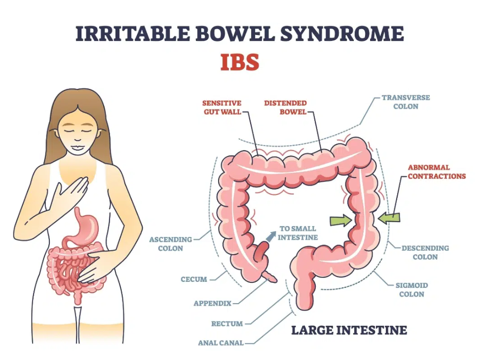 Apa Itu Irritable Bowel Syndrome (IBS)?